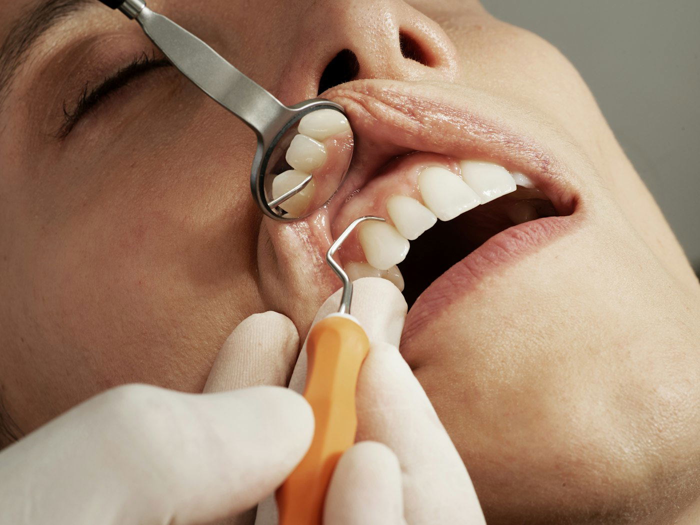 sorriso com lentes de porcelana