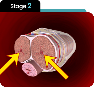Stage 2 — Vessels Open