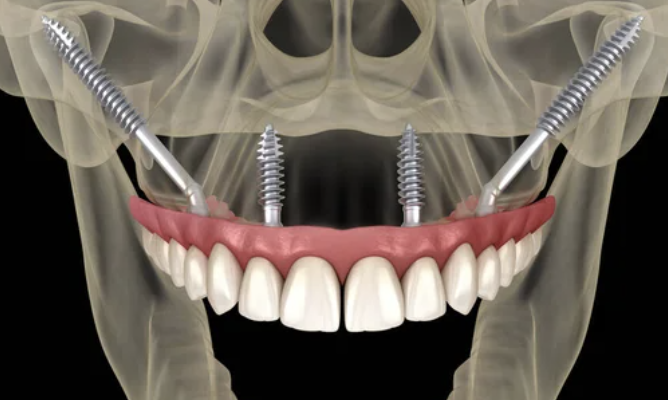 Implantes Zigomáticos