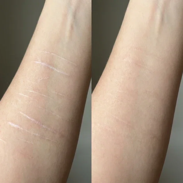 Antes y después de la piel