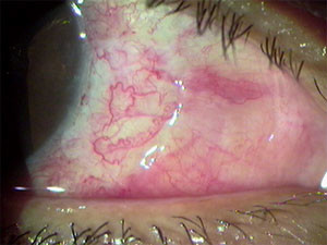 Aspecto do enxerto conjuntival após a cirurgia de pterígio