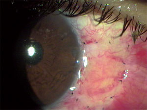 Pterígio sobre a superfície ocular antes do procedimento
