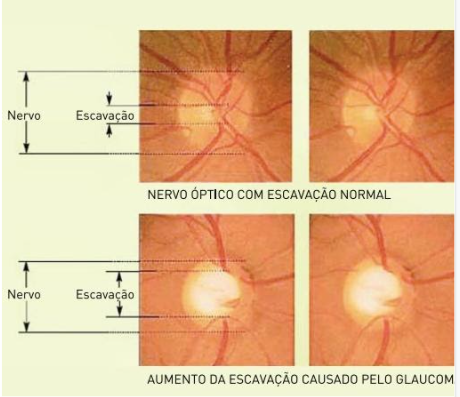Comparação do nervo óptico saudável e com glaucoma