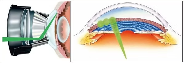 Diagrama da iridotomia a laser