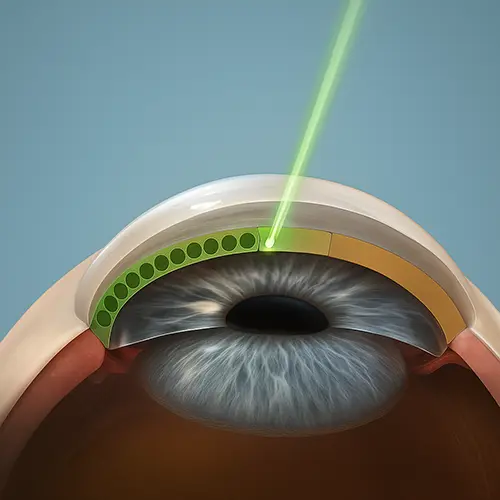 Representação do tratamento do glaucoma com laser SLT