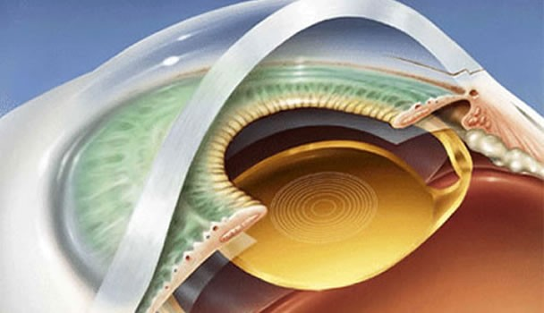 Ilustração de lente intraocular utilizada na cirurgia de catarata