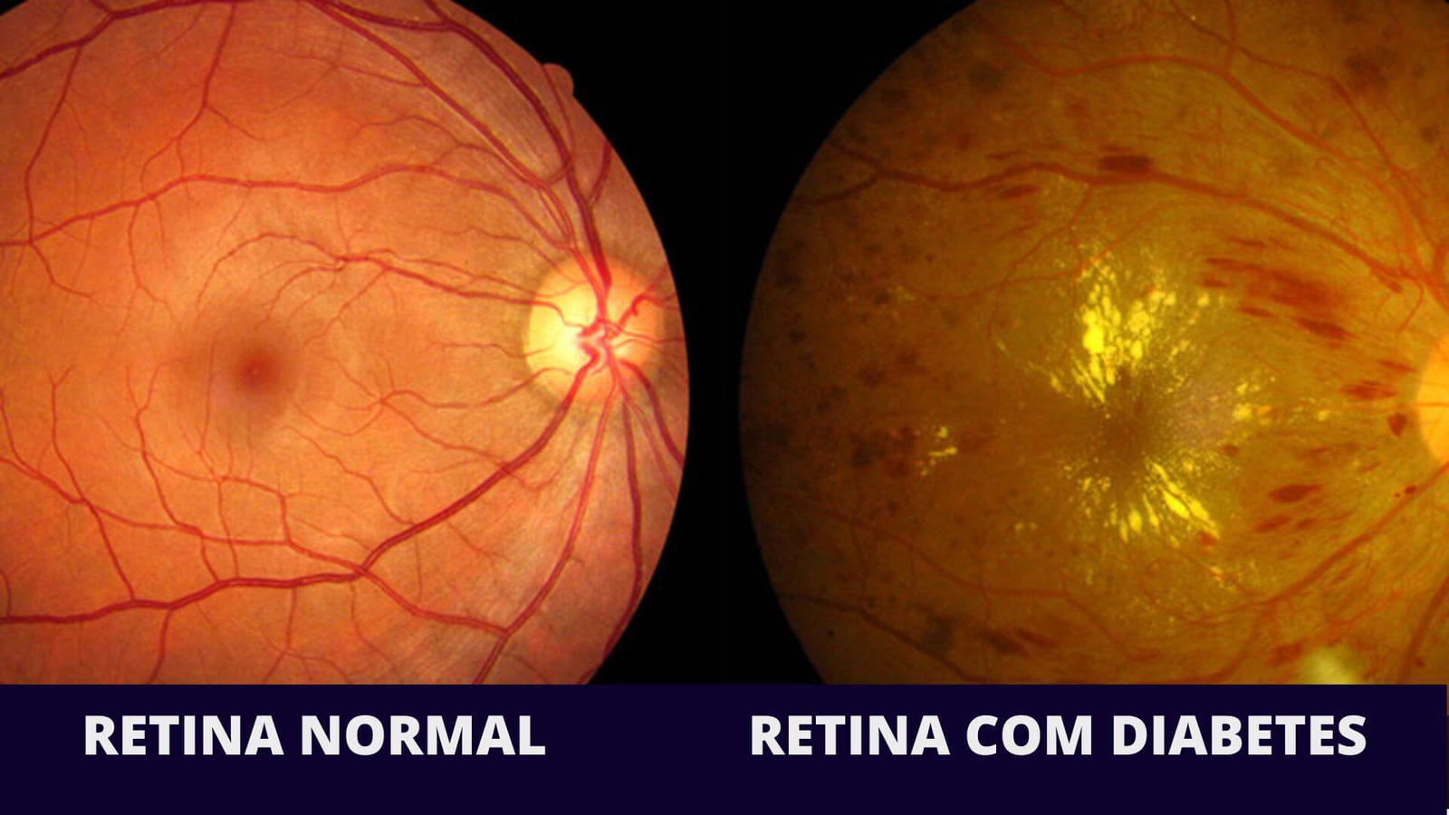 Exame detalhado da retina para diagnóstico de retinopatia diabética no Hospital de Olhos de Palmas