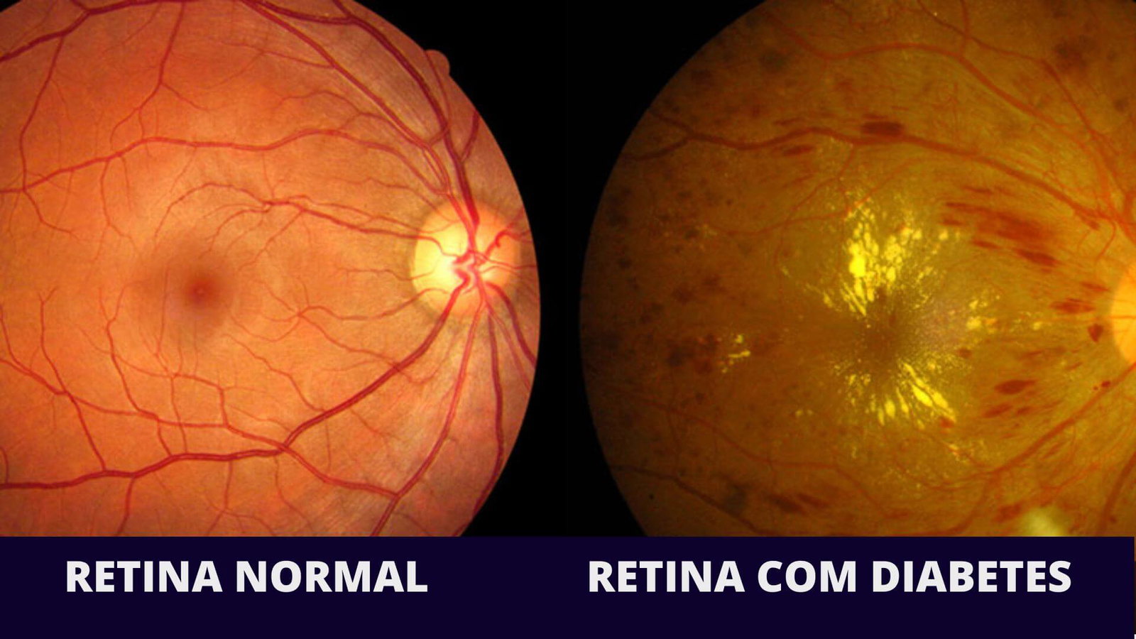 Exame detalhado da retina para diagnóstico de retinopatia diabética no Hospital de Olhos de Palmas