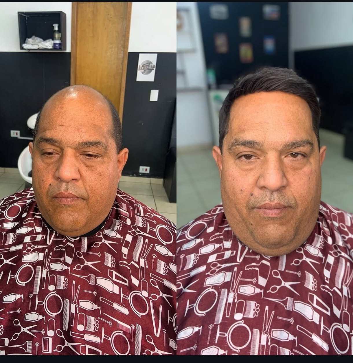 Depois da prótese capilar