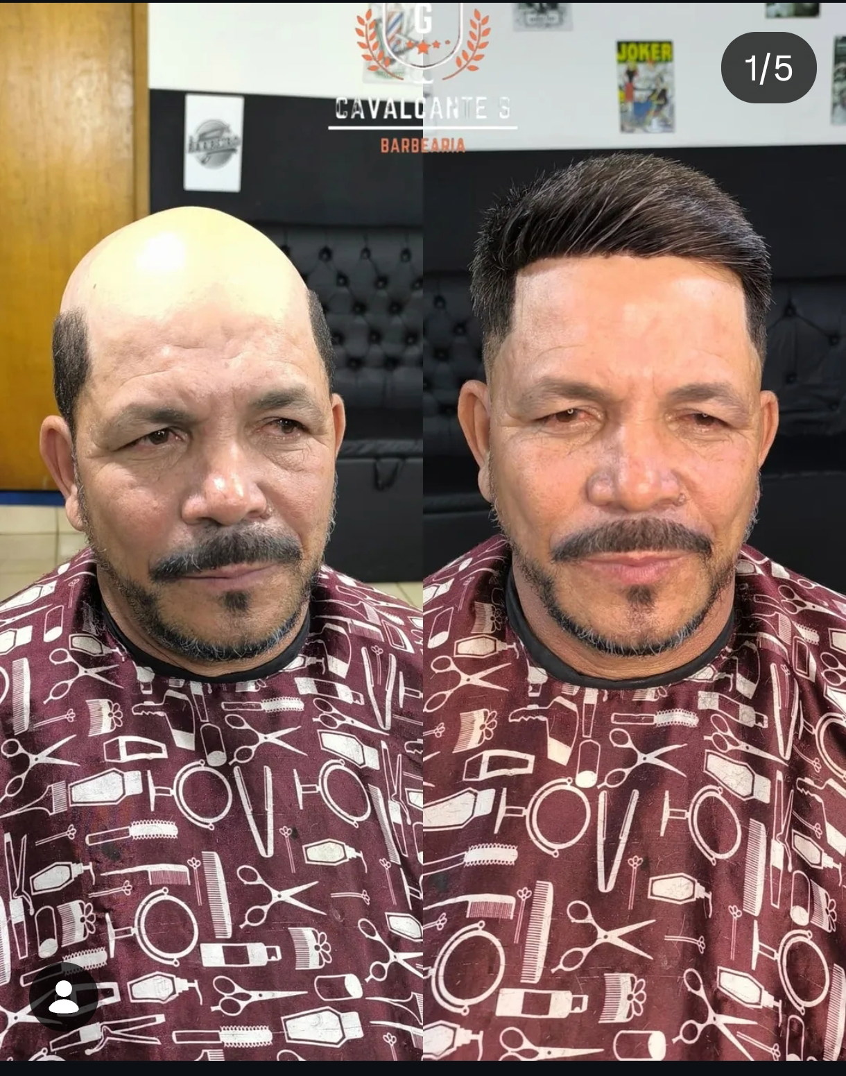 Antes da prótese capilar