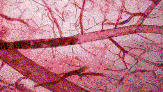 Under magnification, small holes open in the vein wall where fluid escapes into surrounding tissue