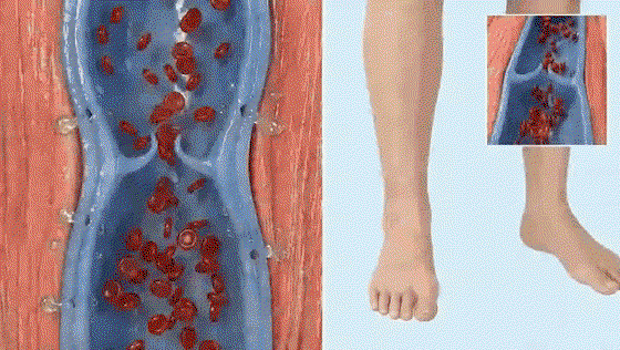 Veins leaking fluid, zooming out to swelling legs