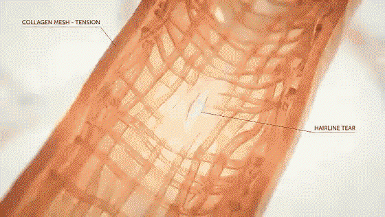 Illustration: fragile vein walls thinning and stretching