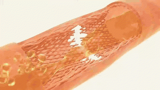 Vein walls tightening and sealing shut