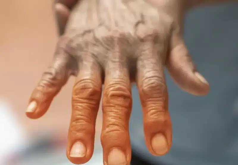 Stiff, swollen hand of an older adult in the morning