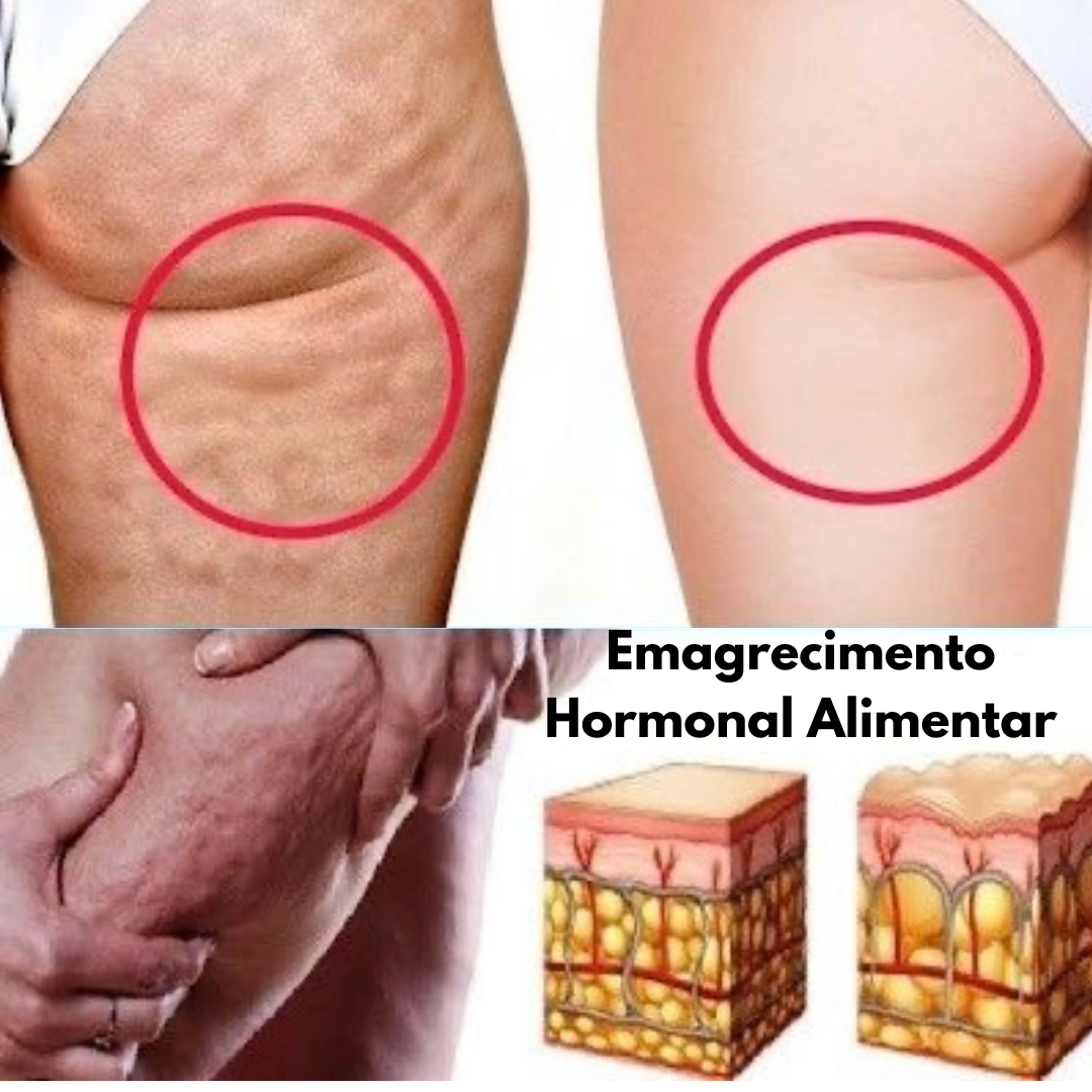 Emagrecimento hormonal alimentar