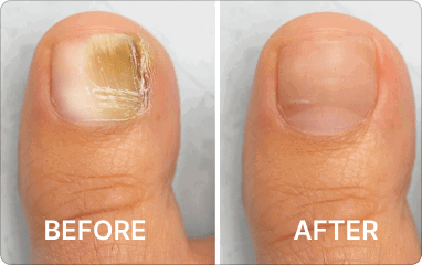 Before - After