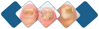 Nail progression