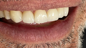 Facetas de Resina, Porcelana e Lentes de Contato Dental na Tijuca