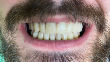 Limpeza Dentária na Tijuca