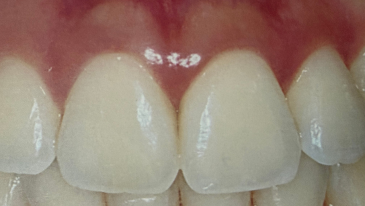 Cirurgia de Gengiva na Tijuca