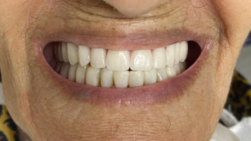 Prótese Dentária na Tijuca
