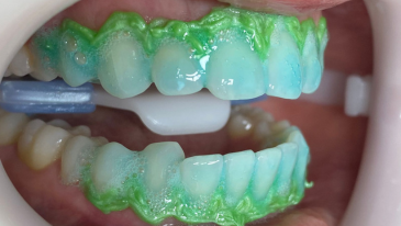 Clareamento Dental na Tijuca