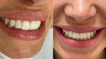 Limpeza Dentária