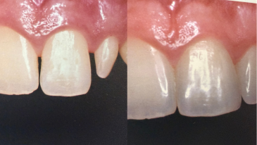 Prótese Dentária na Tijuca