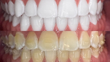 Clareamento Dental na Tijuca