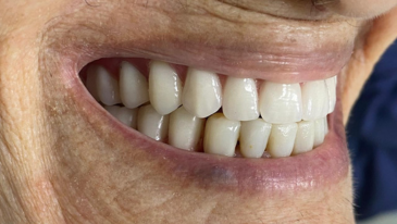Prótese Dentária