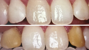 Facetas de Resina, Porcelana e Lentes de Contato Dental na Tijuca