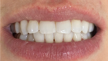 Clareamento Dental na Tijuca