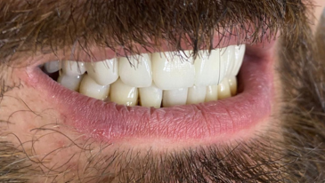 Implante Dentário