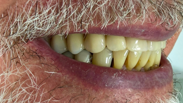 Restauração Dentária