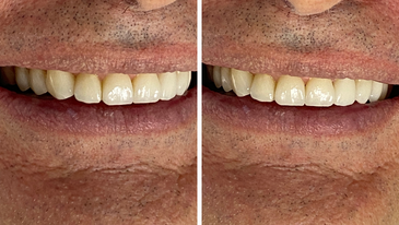 Facetas de Resina, Porcelana e Lentes de Contato Dental na Tijuca