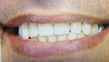 Reabilitação Oral
