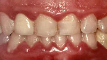 Cirurgia de Gengiva