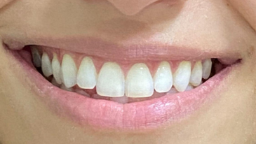 Clareamento Dental