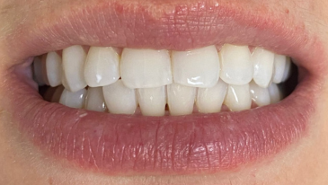 Limpeza Dentária na Tijuca