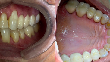 Prótese Dentária na Tijuca